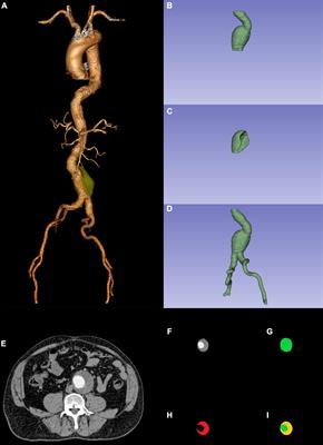 Development and Comparison of Multimodal Models for Preoperative Prediction of Outcomes After Endovascular Aneurysm Repair